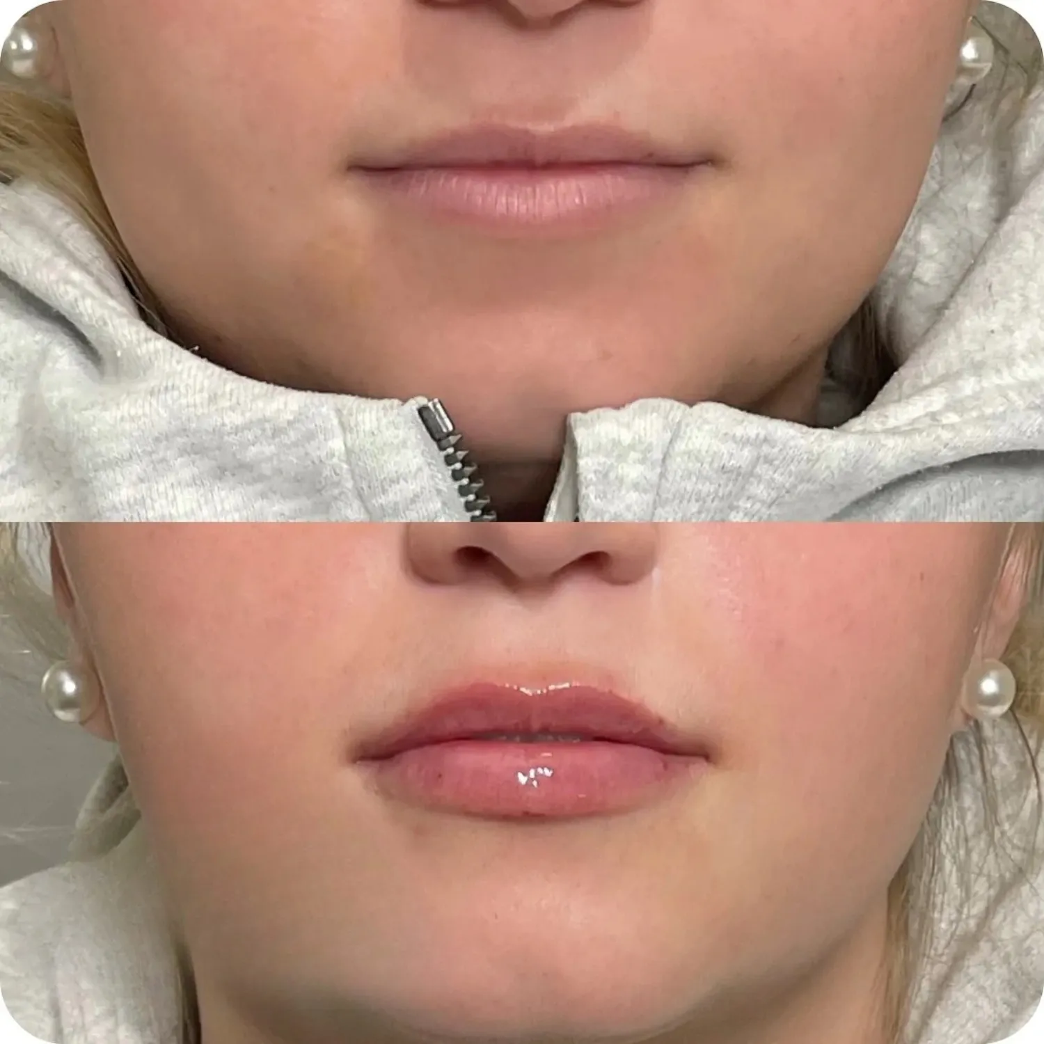 Botox crows feet Before and After seven Refresh Aesthetics