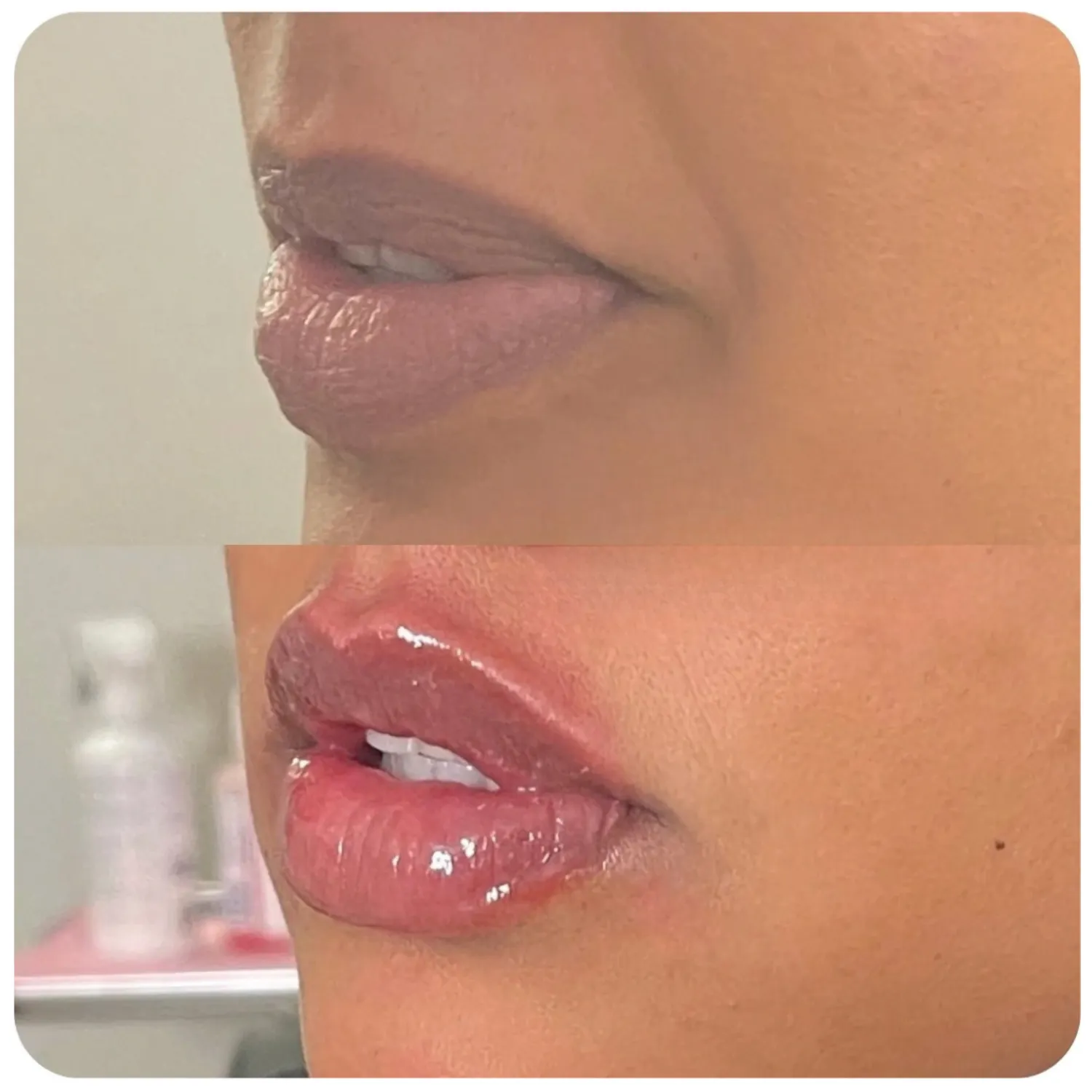Juvederm Ultra Plus Before and After three Refresh Aesthetics