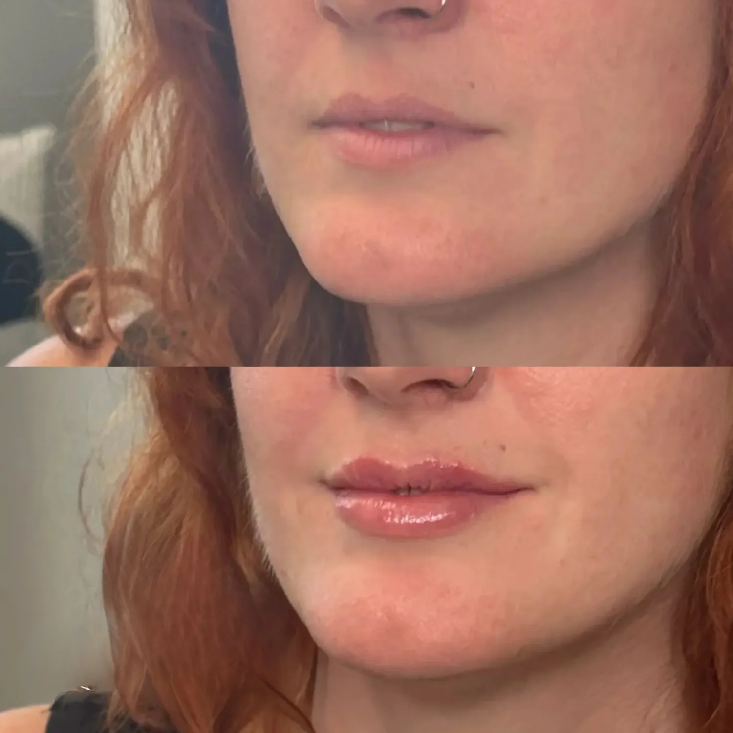 Lip Augmentation Before and After eight Refresh Aesthetics