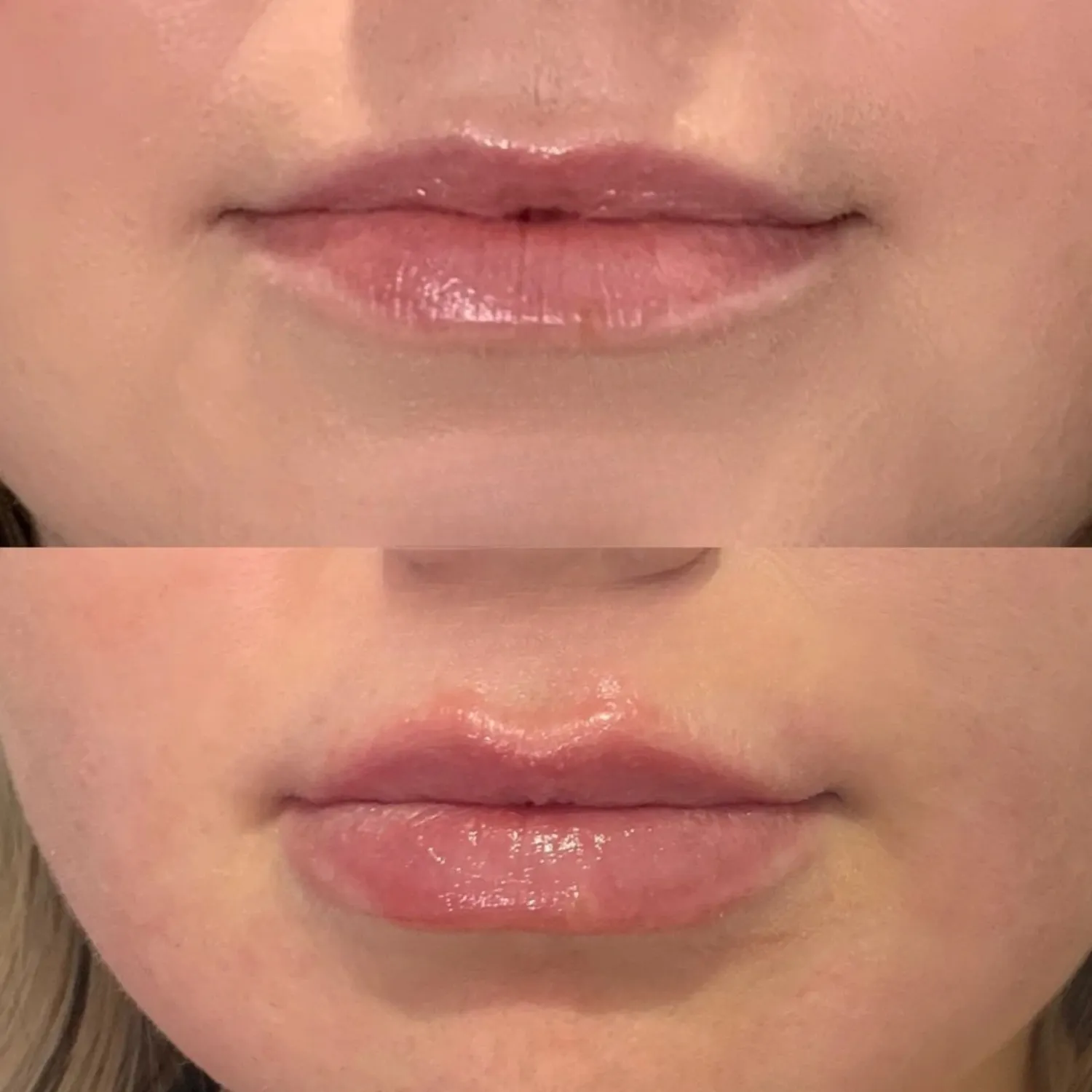 Lip Augmentation Before and After five Refresh Aesthetics