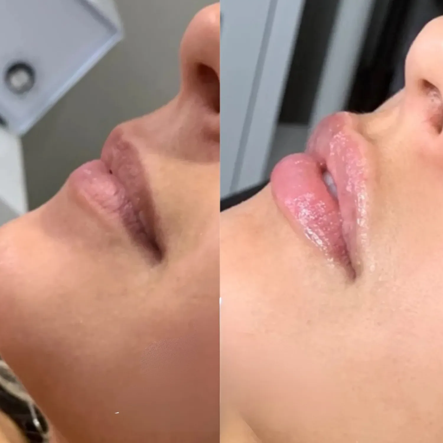 Lip Augmentation Before and After one Refresh Aesthetics