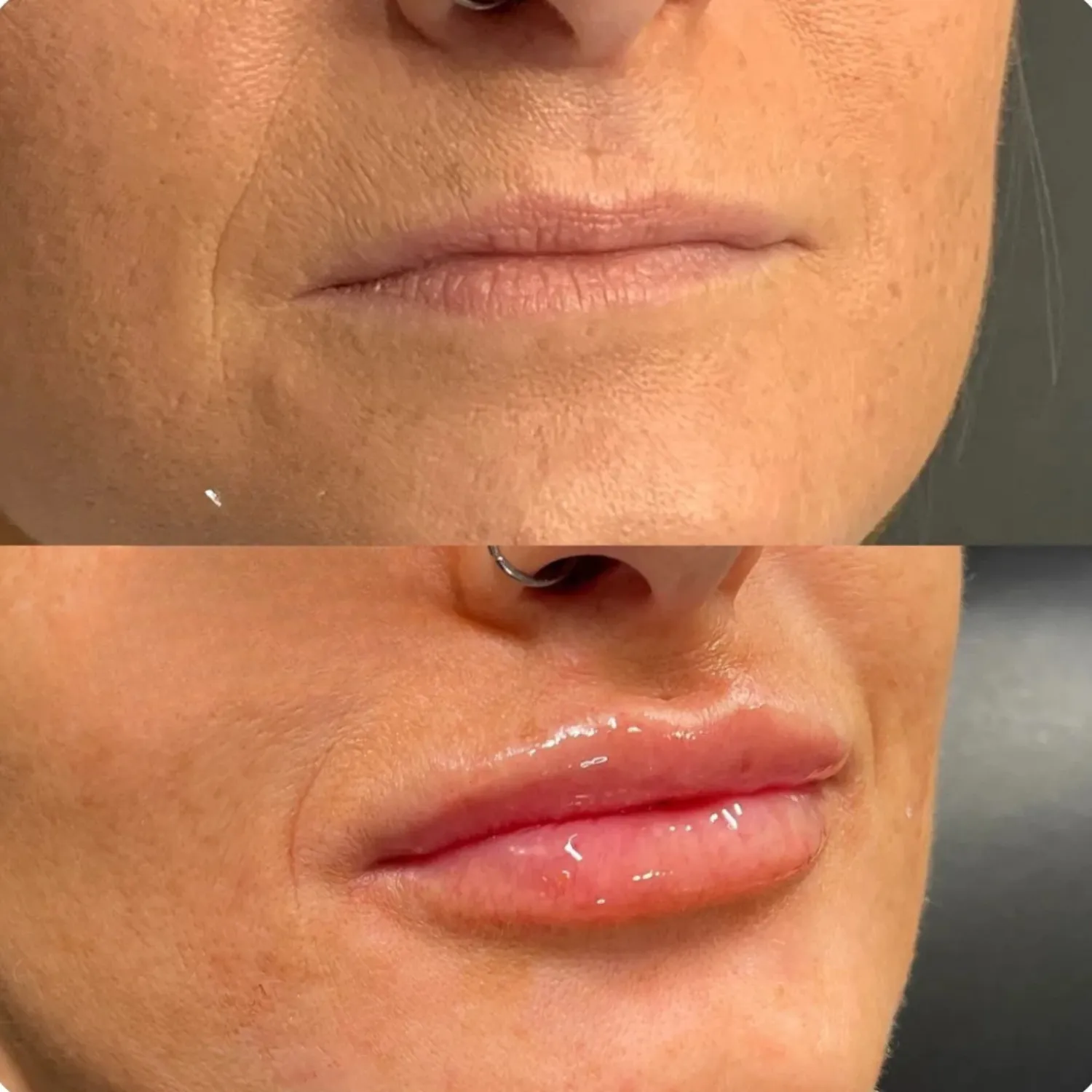 Lip Augmentation Before and After six Refresh Aesthetics