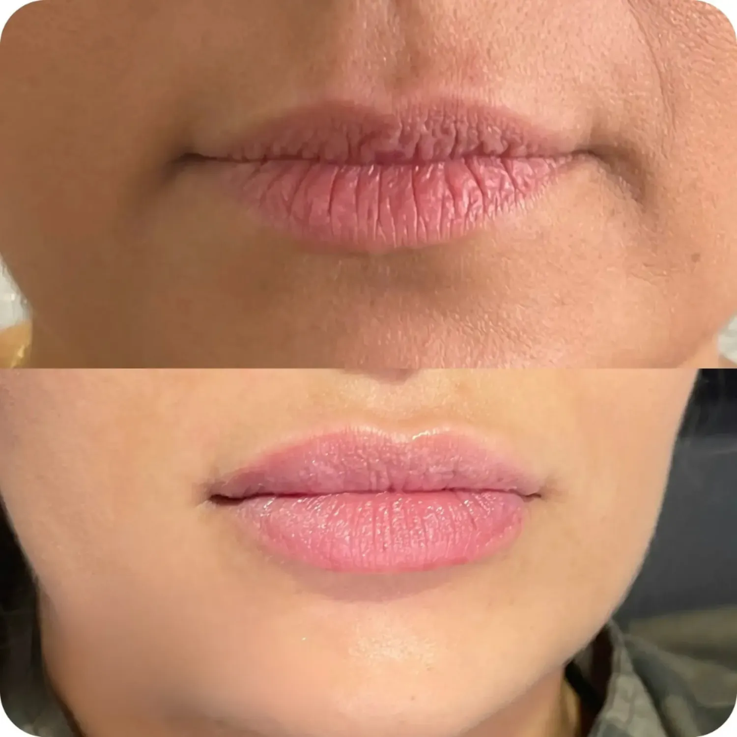 Refresh Aesthetics Lip Augmentation Before and After ten