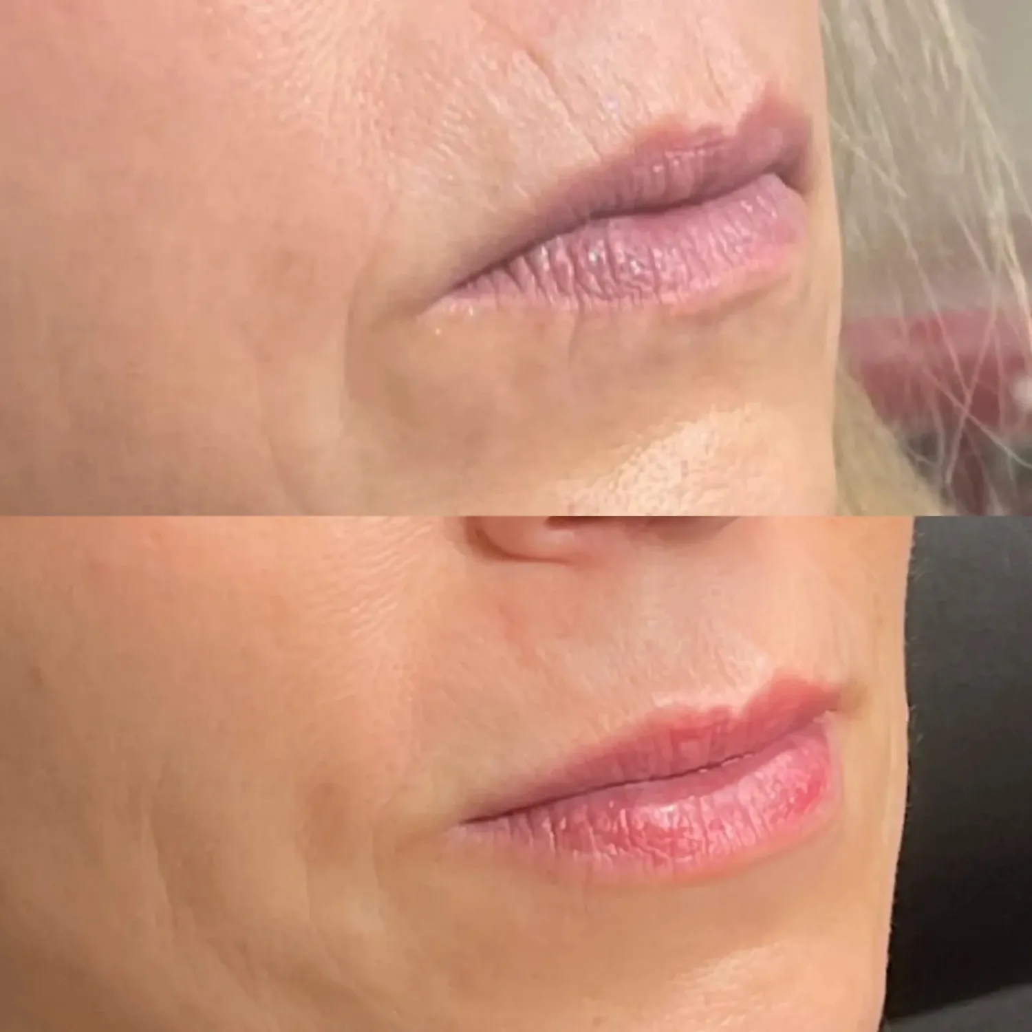 Lip Augmentation Before and After two Refresh Aesthetics