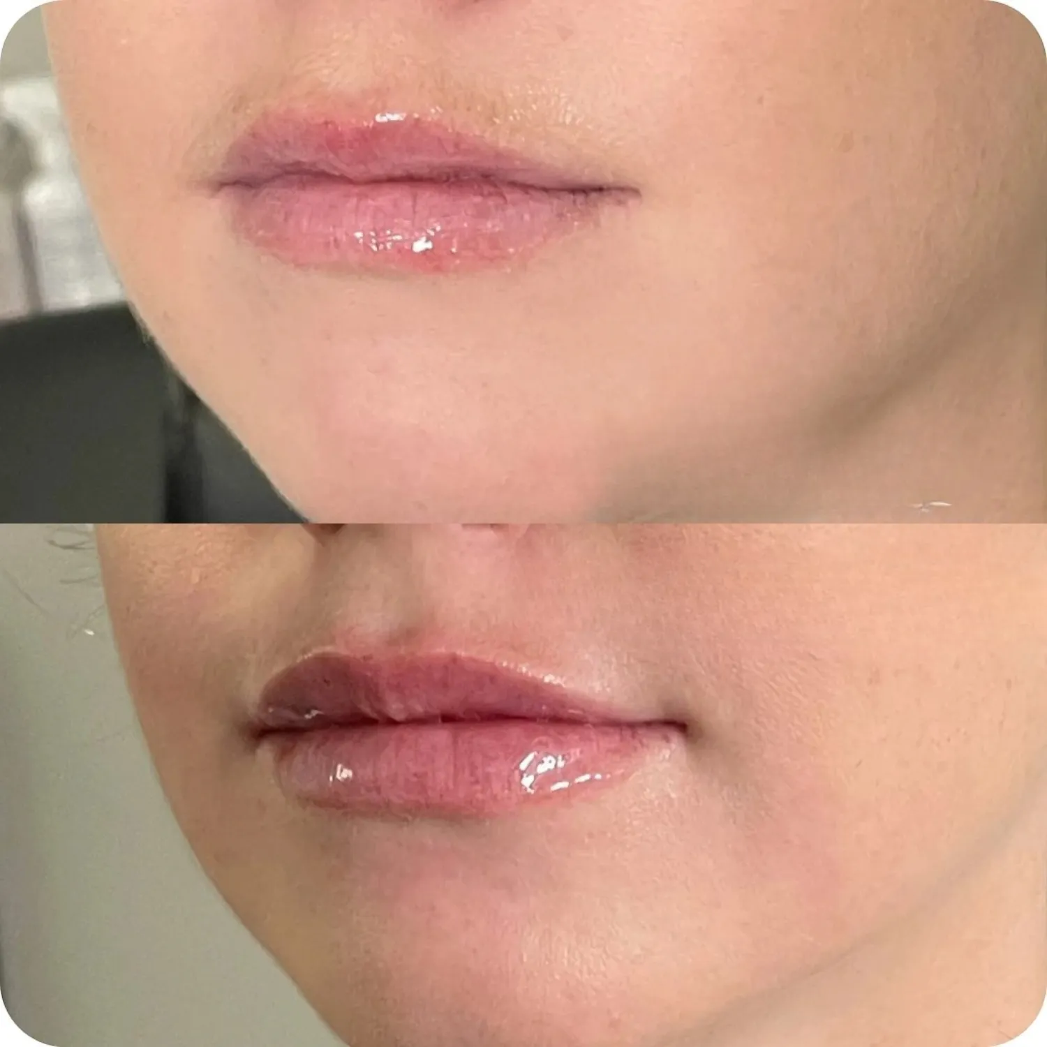 Restylane Refyne Before and After four Refresh Aesthetics