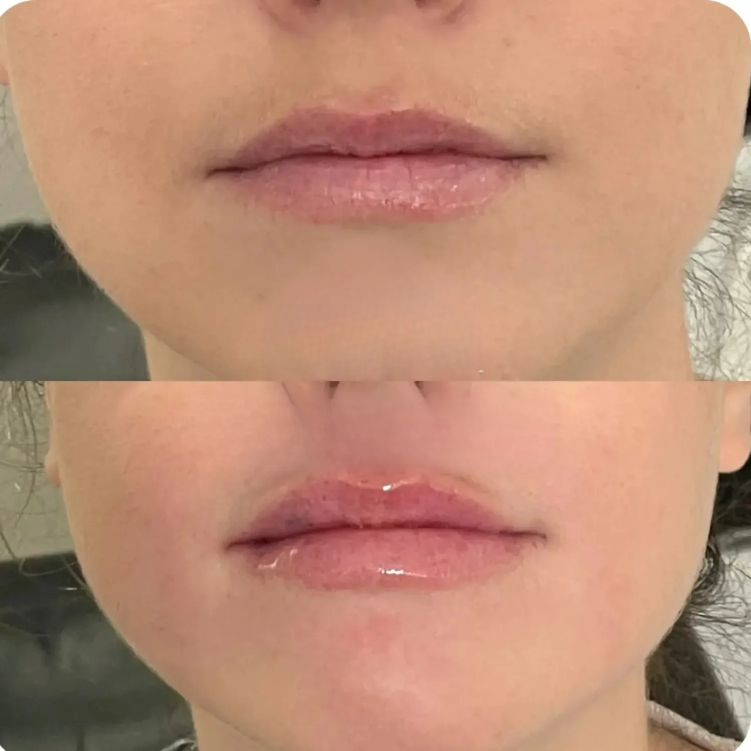 Restylane Refyne Before and After nine Refresh Aesthetics